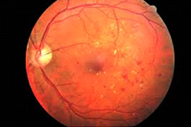 Barrage of the macular area